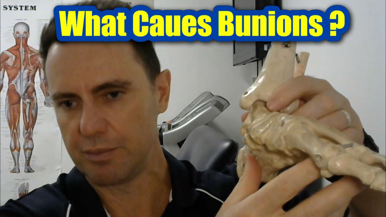 Bunions What Causes Bunions and Treatment Docpods