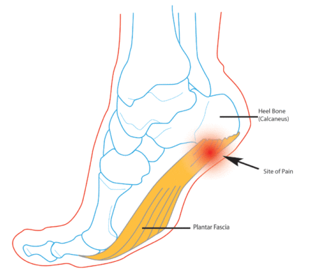 Knee Pain