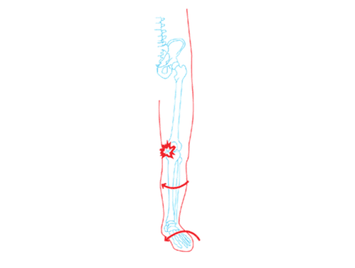 Knee Pain