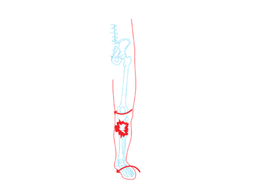Knee Pain
