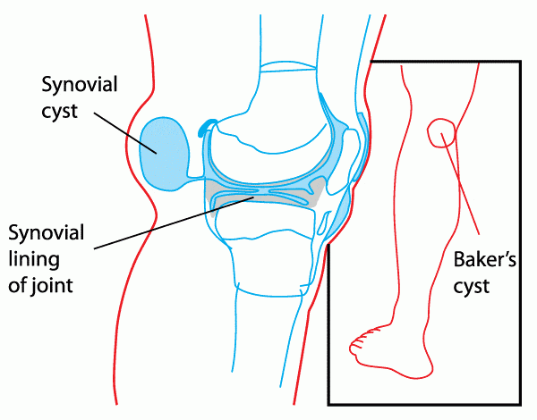 Bakers Cyst Popliteal Cyst Docpods Austrailia