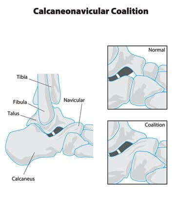 Tarsal Coalition - Docpods Australia