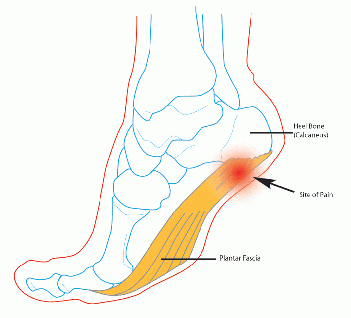 Site of pain for Plantar Fasciitis