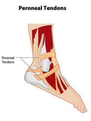 Peroneal Tendon Subluxation - Docpods Australia