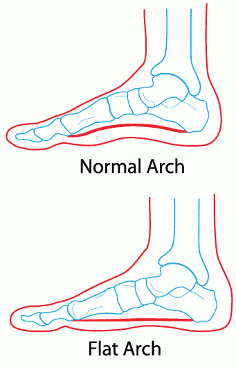 Pes Planus Flat Feet - Docpods Australia