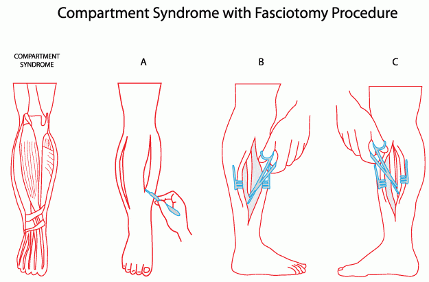 Posterior Compartment Syndrome Docpods Australia