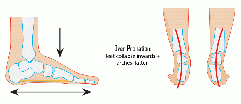 Overpronation of the foot means your foot rolls inward when you walk.